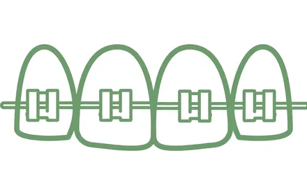 Illustration alignement dentaire par gouttières